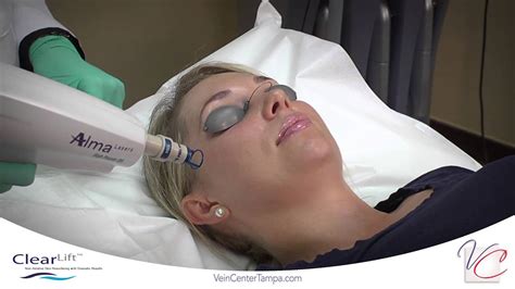 clearlift q switched yag vein and cosmetic center of tampa bay youtube