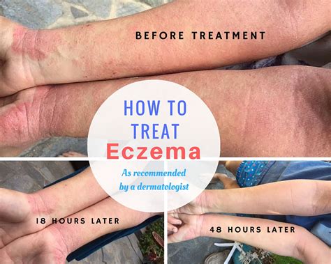 How To Treat Eczema Severe Case Of Eczema Fruit Heights Friends