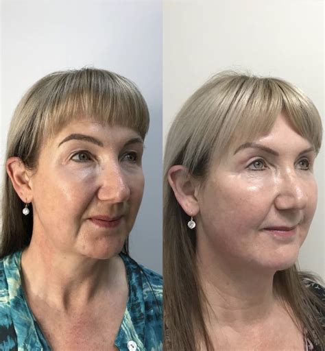 Threadlift Non Surgical Face Lift Available At Body Dezign House