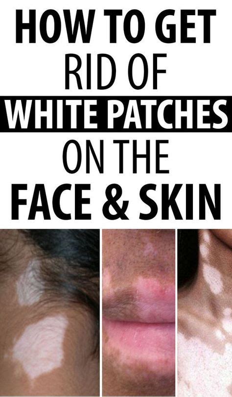 How To Get Rid Of White Patches On The Face White Patches Skin How