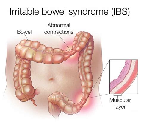 Ibs is a type of functional gi disorder, continues dr. Gastroenterologists In Florida | Irritable Bowel Syndrome ...