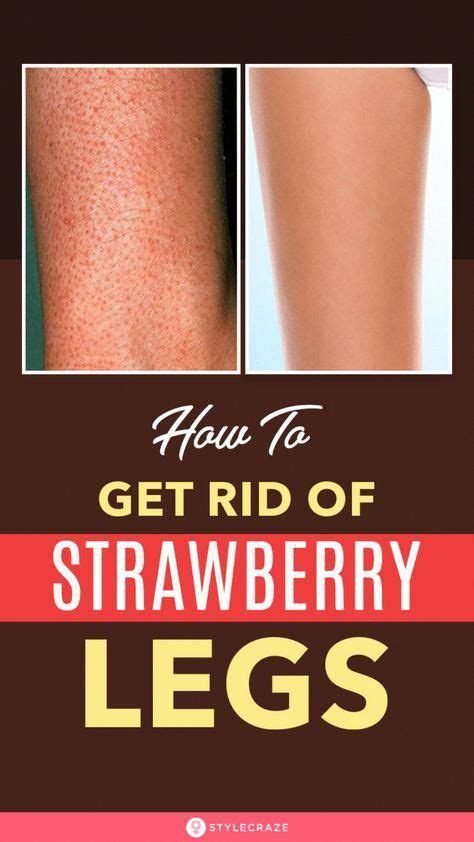 10 Natural Ways To Get Rid Of Strawberry Legs In 2020 Strawberry Legs