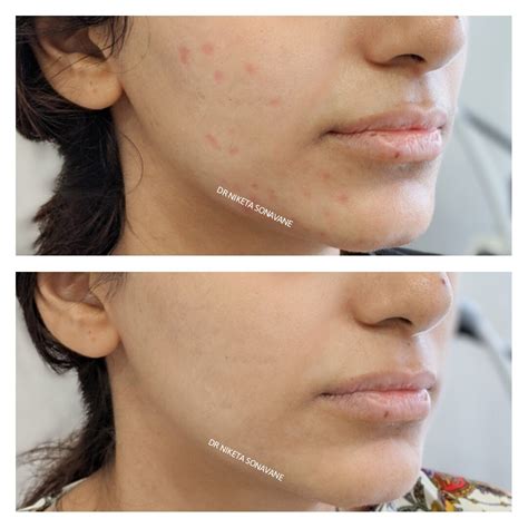 Acne Scar Treatment In Mumbai Cost Before After Results Laser