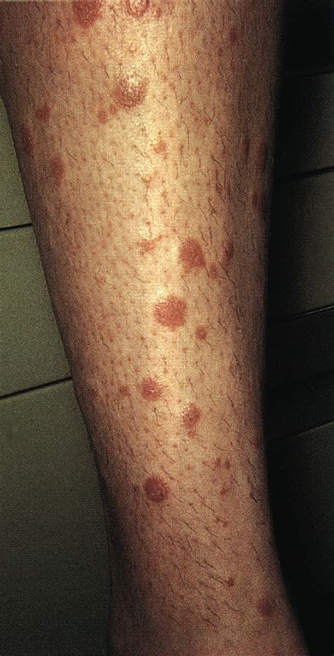What You Should Know About Lichen Planus