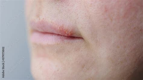 Herpes Sore On Lips Vesicles Small Bumps Pimples Blisters On Upper Lip