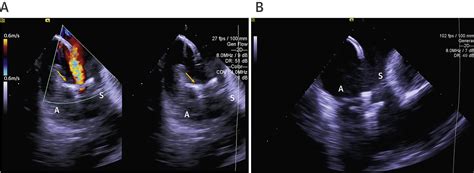 4 Dimensional Intracardiac Echocardiography In Transcatheter Tricuspid