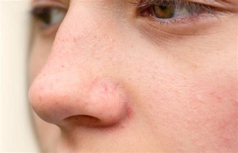 7 Ways To Address Broken Blood Vessels On The Face