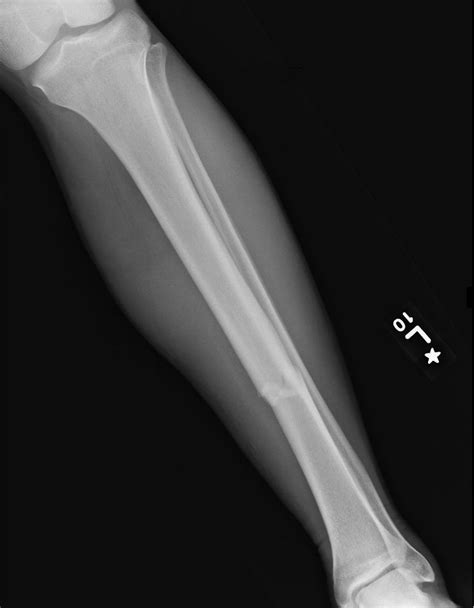 Nondisplaced Tibial Plateau Fracture Icd 10