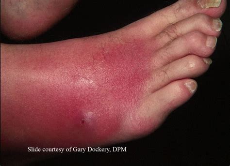 Bacterial Infections As Related To Cellulitis Pictures