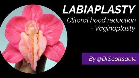 Labiaplasty Clitoral Hood Reduction Vaginoplasty By Drscottsdale