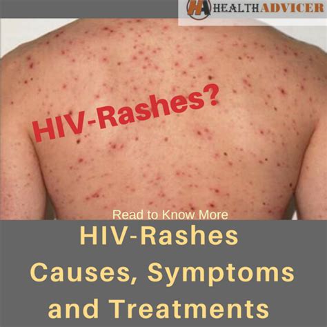 Skin Rashes And Arv S Living With Hiv In The Philippines Vrogue