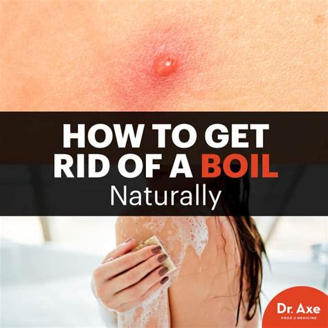 Thousands of people often can get infected during these outbreaks. Hot to Get Rid of a Boil & How to Prevent Boils - Dr. Axe