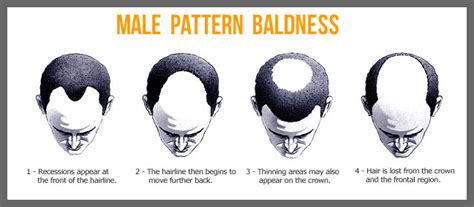 About Baldness Types Of Baldness