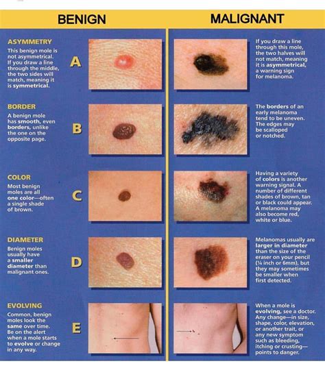 Different Between Benign And Malignant Skin Lesion Health Tz