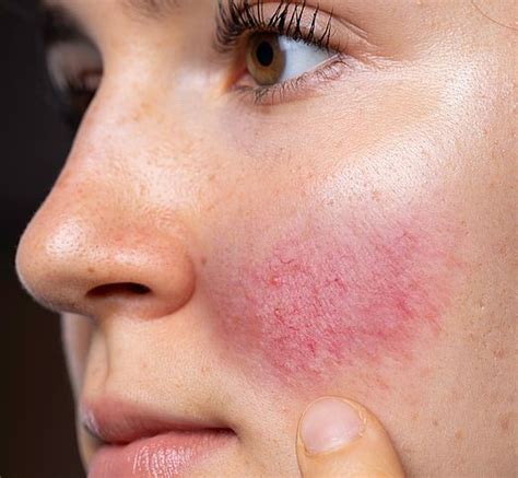 Rosacea And Diffuse Redness Skin Concerns Geelong