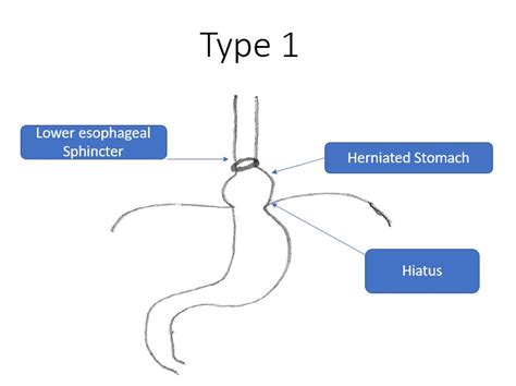 Paraesophageal Hernia Types