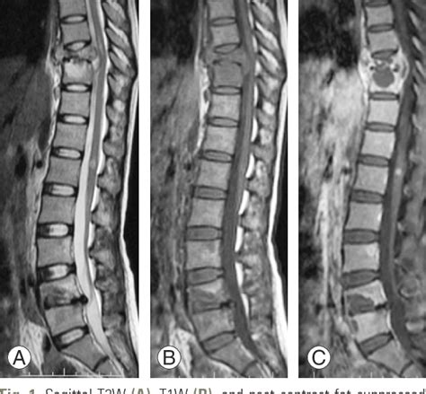 Figure 1 From Role Of Whole Spine Screening Magnetic Resonance Imaging