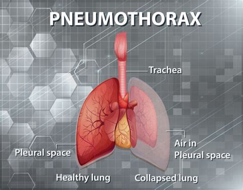 Pneumothorax Diagnosis And Management In The Ed Pedmore Medical
