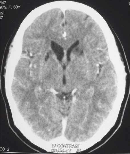 Contrast Enhanced Ct Scan Of The Brain Showing Bilateral Gliotic