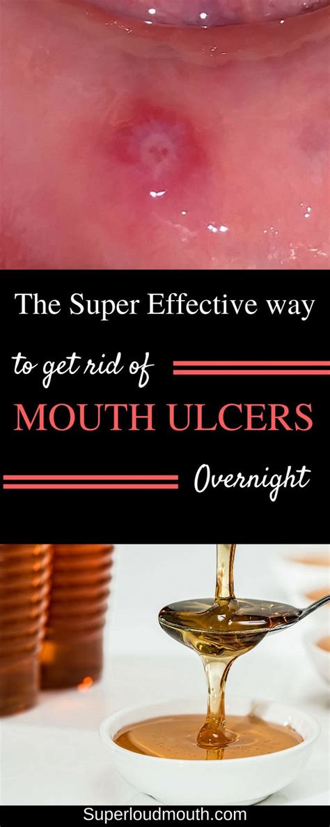 31 Home Remedies To Get Rid Of Mouth Ulcerssores Mouth Ulcers