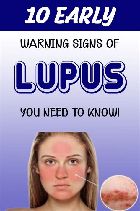 Here Are Early Warning Signs Of Lupus You Need To Know Health