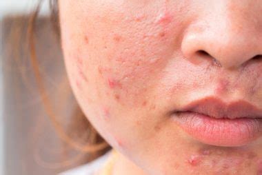 Those caused by a loss of tissue (atrophic scars), and those caused by an excess of tissue (hypertrophic scars). How to Treat 5 Common Types of Acne Scars | Reader's Digest