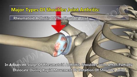 5 Major Types Of Shoulder Arthritis Osteoarthritis Rheumatoid Septic