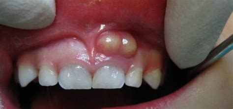 A Bump On The Gum In A Child Above The Tooth Purulent White What To Do