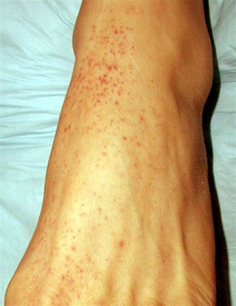 What Are The Most Common Causes Of A Petechial Rash