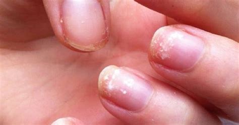 My Fingernails Are Turning White