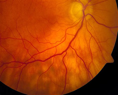 Ocular Adnexal Lymphoma Masquerading As Glaucoma Consult Qd