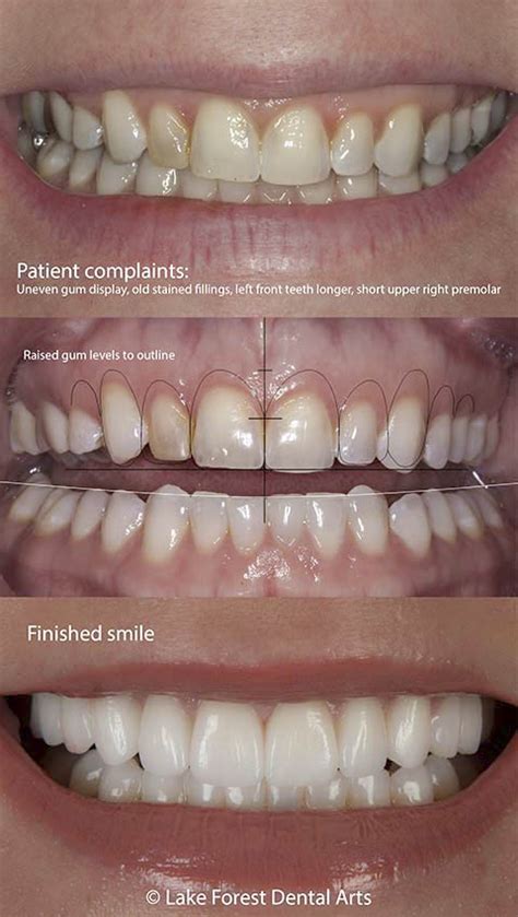 Straighten Crooked Teeth Veneers To Correct Tooth Alignment