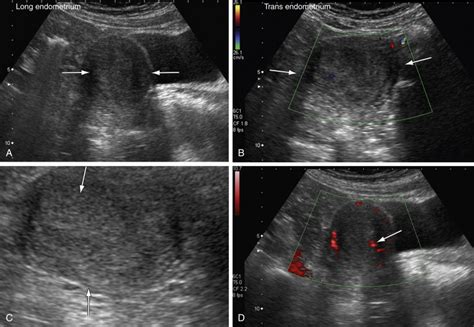 Uterine Cancers Radiology Key