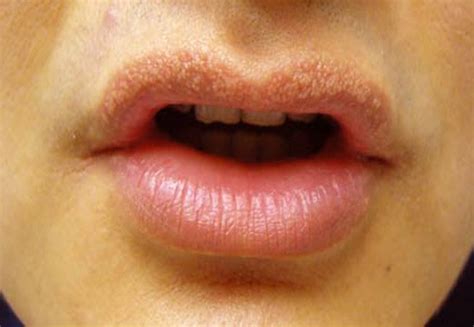 Bumps On Lips Causes Treatment Pictures 2020 Updated