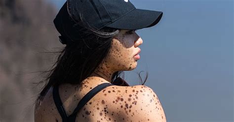 Living With A Skin Condition POPSUGAR Beauty