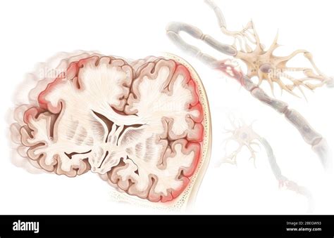 Blessure à La Tête Fermée Avec Le Cerveau Banque De Photographies Et D