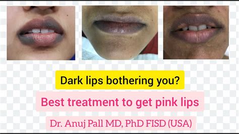 Smoking Lips Laser Treatment Lipstutorial Org