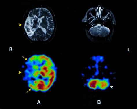 Brain Spect In Clinical Practice Part I Perfusion Journal Of