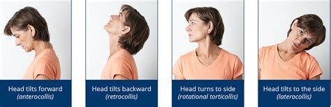 Spasmodic Torticollis Cervical Dystonia Get Images