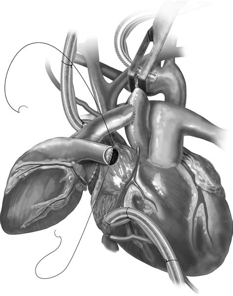 Heterotopic Heart Transplantation Technical Considerations Operative