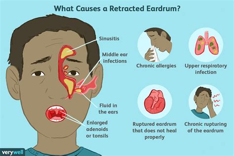 Retracted Eardrum Causes Symptoms Causes And Treatment