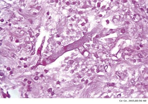 Mucormycosis is a very rare infection. Networks of aseptate hyphae in straight angle, secondary ...