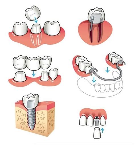 Dentaltown A Dental Prosthesis Is An Intraoral Inside The Mouth