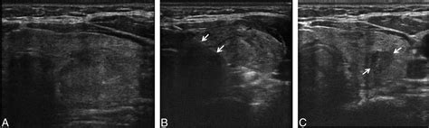 Thyroid No Surgery 101 Radiofrequency Rfa Of A Benign Symptomatic