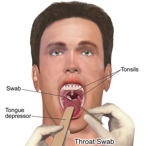 Strep Throat Symptoms Causes Diagnosis Treatment And Prevention