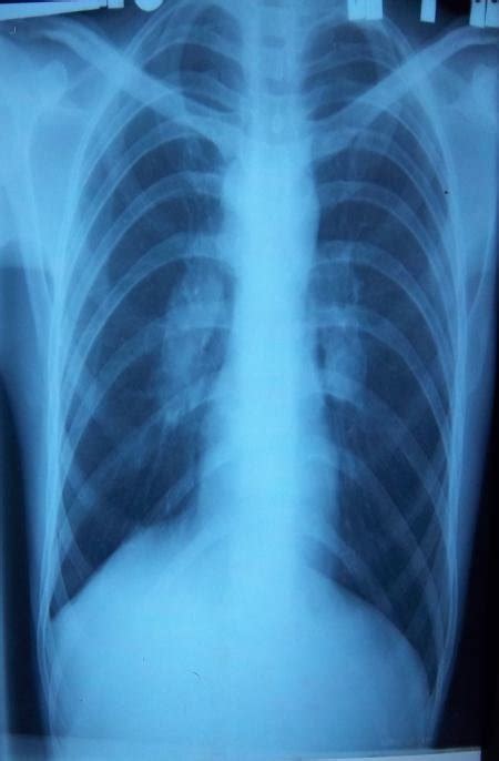 X Ray Chest Pa View Shows Bilateral Hilar Lymph Adenopathy