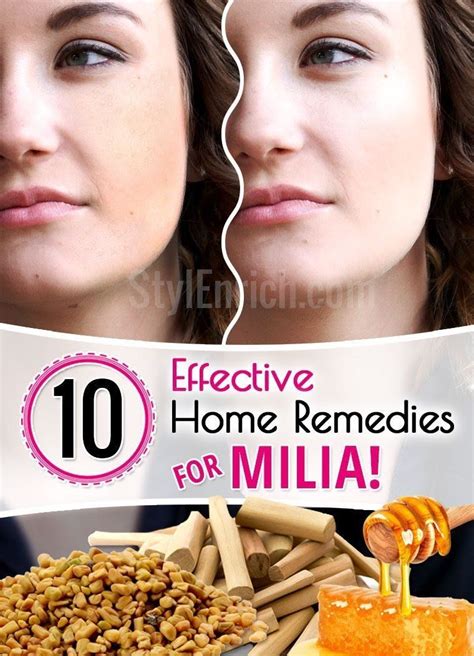 Home Remedies For Milia How To Treat Milia On Face At Home Itself