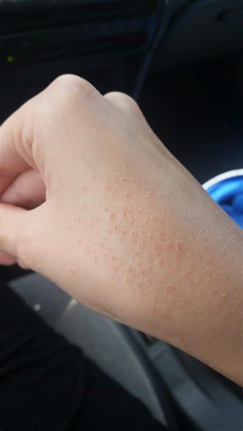 Dry Skin Bumps On Hands