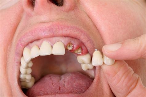 Use These 4 Easy Tips When Seeking Wisdom Teeth Removal In Burlington