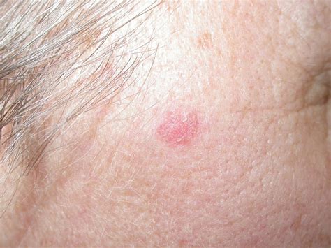 Topical Skin Cream For Treatment Of Basal Cell Carcinoma Shows Promise